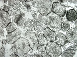 M,15y. | clin. susp. cardiomyopathy - left ventricle M,15y. | clin. susp. cardiomyopathy - left ventricle